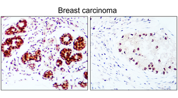 Breast Cancer Biomarkers Antibody Panel