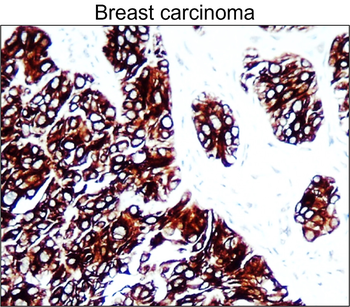 Breast Cancer Biomarkers Antibody Panel