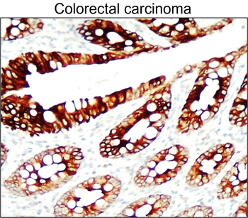 Colorectal cancer biomarkers Antibody Panel