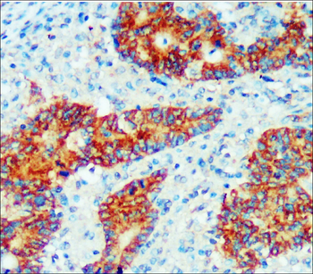 Colorectal cancer biomarkers Antibody Panel