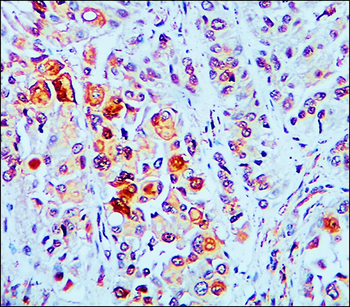 Lung cancer biomarkers Antibody Panel