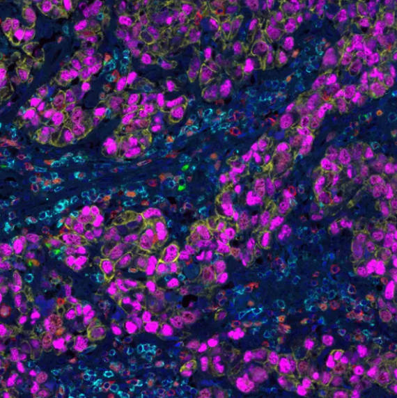 Tumor Proliferation and Metastasis Antibody Panel
