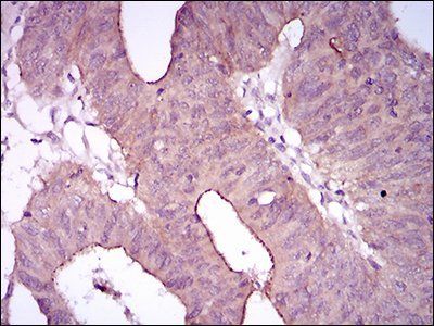 EGFR mutant