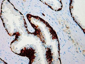 Basal Cell Marker Cocktail 1, p63 Protein + HMW Cytokeratin