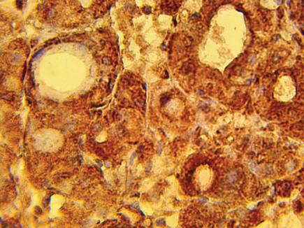 Rabbit anti Human Ribonucleoside-diphosphate reductase, large subunit (RRM1) Antibody